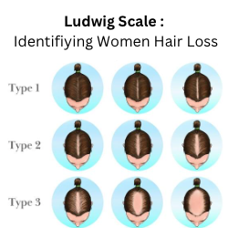 Ludwig Style Hair Loss 