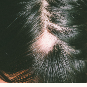 What's PCOS Hair Loss?